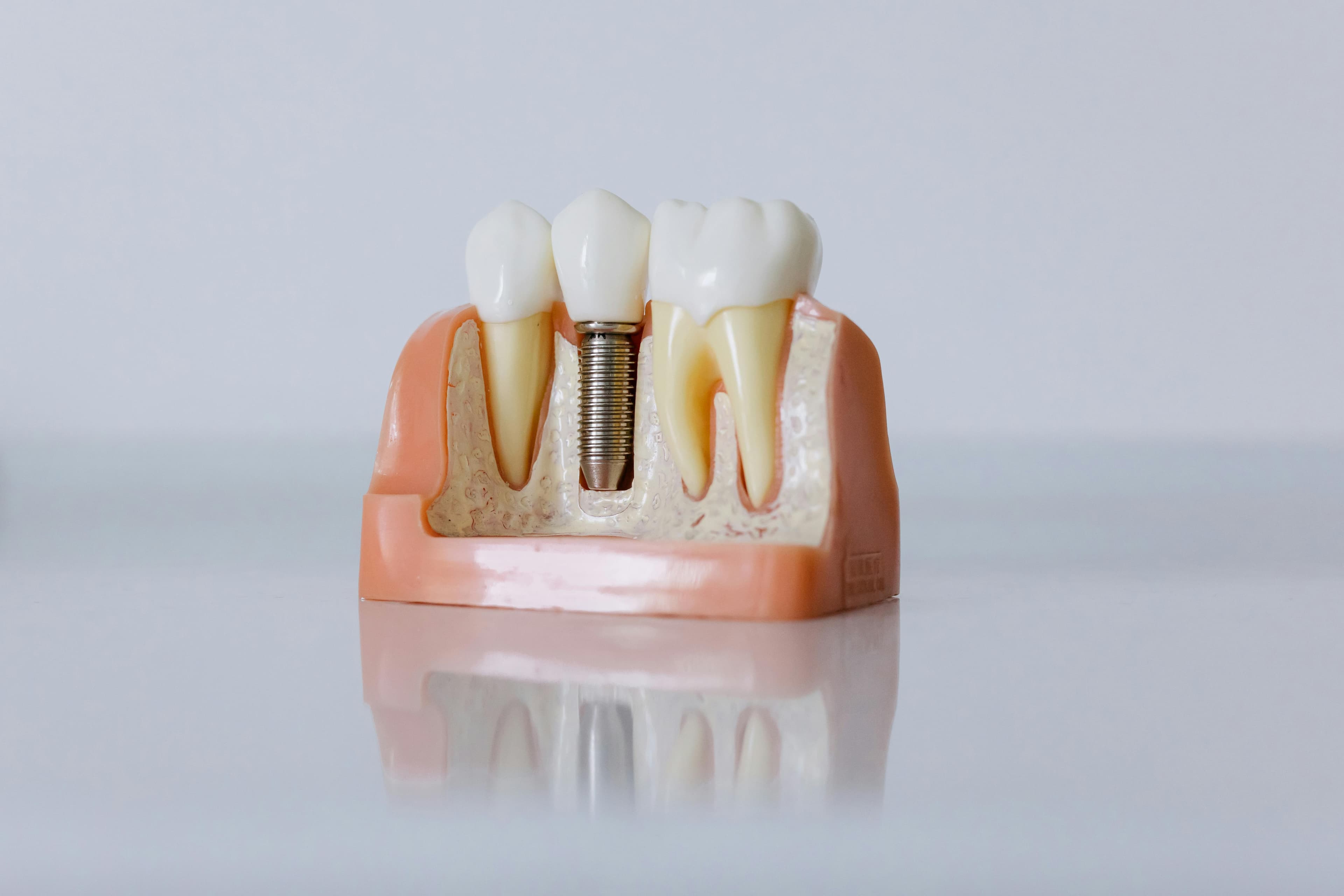 Implant unitaire · Après